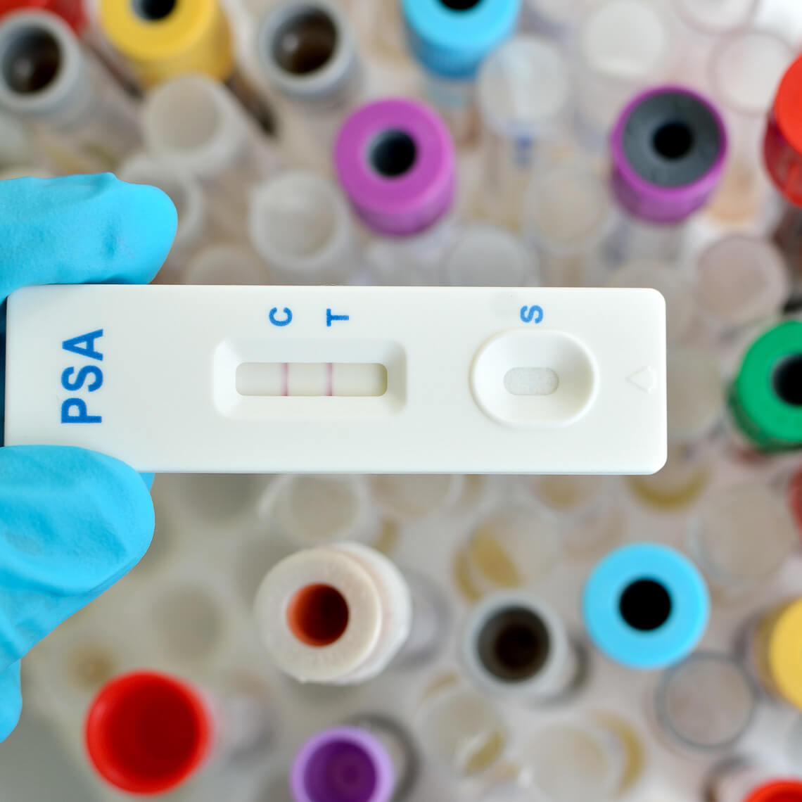 PSA testing by using test cassette, the result showed positive (double red line)